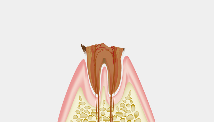 C4：歯の根だけ残った末期の虫歯